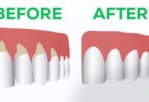 Si të shëroni mishrat e dhëmbëve me këto ilaçe natyrale