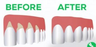 Si të shëroni mishrat e dhëmbëve me këto ilaçe natyrale