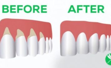 Si të shëroni mishrat e dhëmbëve me këto ilaçe natyrale