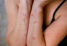 Pickimet e mushkonjave, si të shpëtojme prej tyre dhe rastet kur duhet të shkojmë tek mjeku