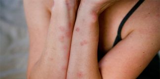 Pickimet e mushkonjave, si të shpëtojme prej tyre dhe rastet kur duhet të shkojmë tek mjeku