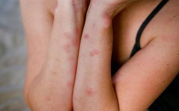 Pickimet e mushkonjave, si të shpëtojme prej tyre dhe rastet kur duhet të shkojmë tek mjeku