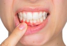 Metoda natyrale/ Si të kuroni infeksionet në mishrat e dhëmbëve nga shtëpia