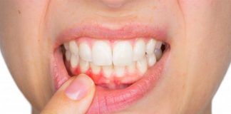 Metoda natyrale/ Si të kuroni infeksionet në mishrat e dhëmbëve nga shtëpia