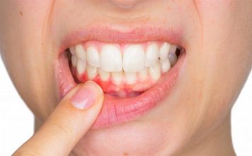 Metoda natyrale/ Si të kuroni infeksionet në mishrat e dhëmbëve nga shtëpia