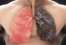 Këshilla/ Si të pastroni mushkëritë në mënyrë natyrale