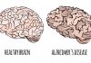 Zbulohet ilaçi kundër alzhajmerit, vonon me 5 muaj degradimin e trurit tek njeriu
