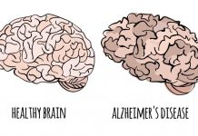 Zbulohet ilaçi kundër alzhajmerit, vonon me 5 muaj degradimin e trurit tek njeriu