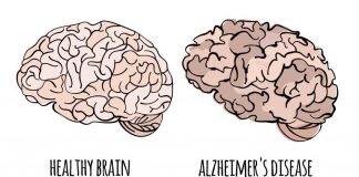 Zbulohet ilaçi kundër alzhajmerit, vonon me 5 muaj degradimin e trurit tek njeriu