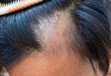 Rënia e Flokut, si ta Zgjidhni Problemin që në Rrënjë!