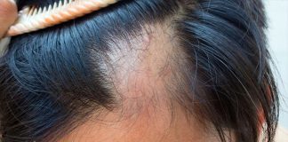 Rënia e Flokut, si ta Zgjidhni Problemin që në Rrënjë!